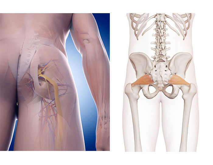 Piriformis Syndrome Signs & Symptoms